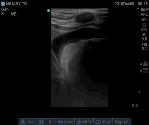  Linear high frequency array used to confirm and evaluate the small pericardial effusion. 