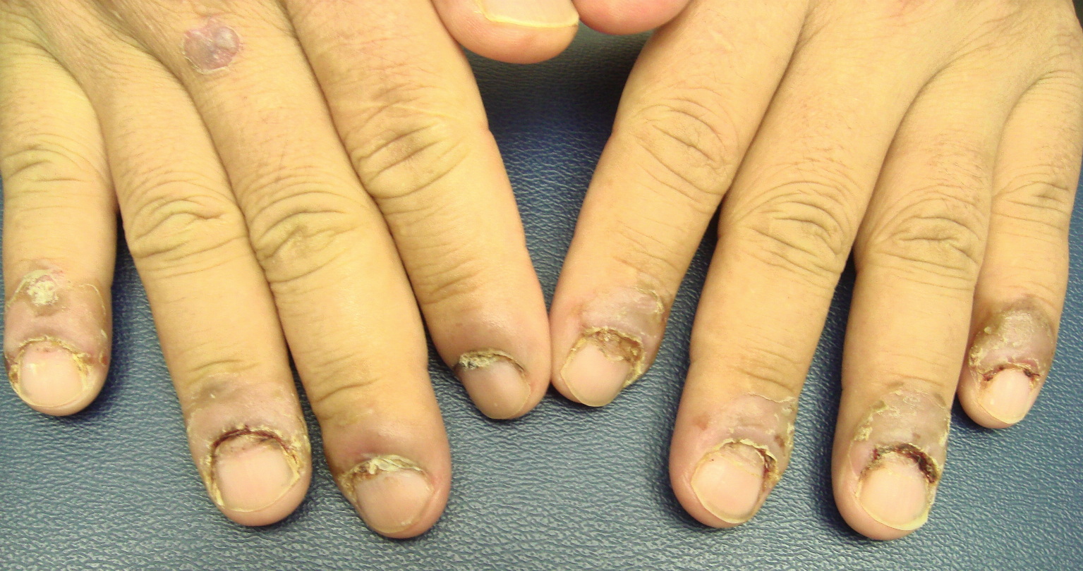nail diseases #whitenails #koilonychia #nailpsoriasis - YouTube