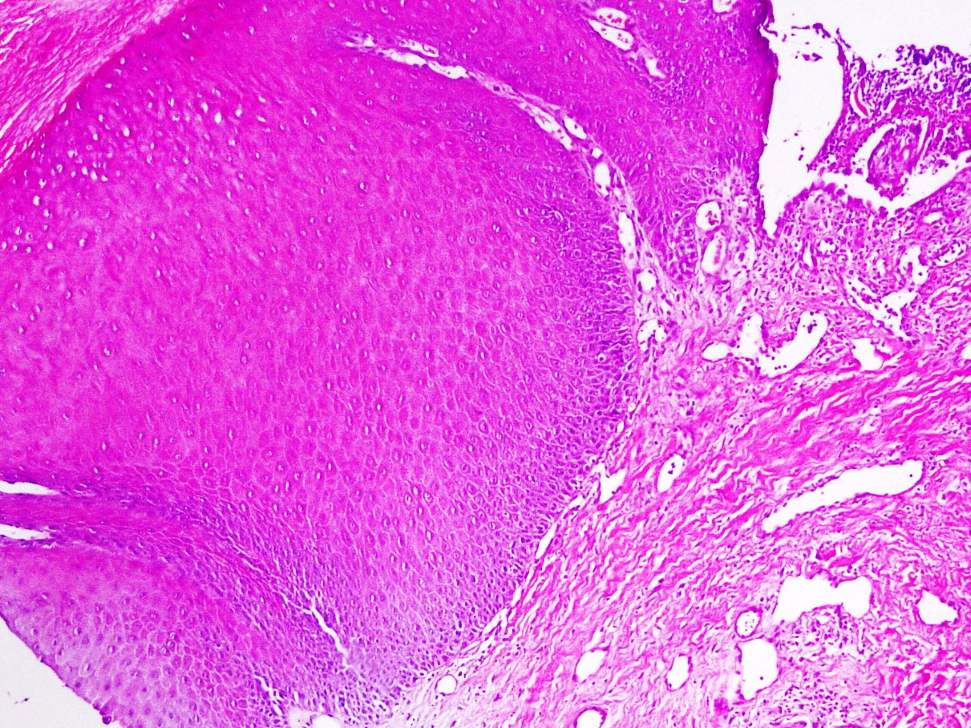 Erosions On A Prolapsed Uterine In An Old Woman An Unusual