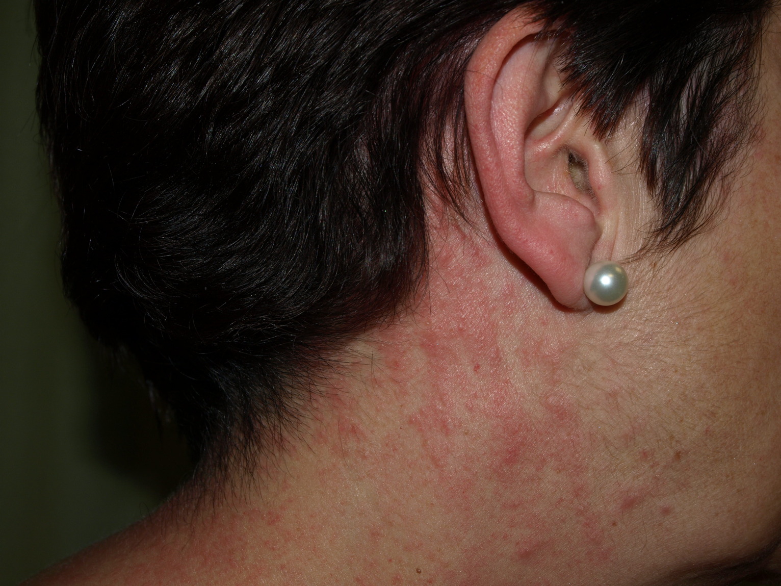Dermatitis Shiitake En Una Paciente Española