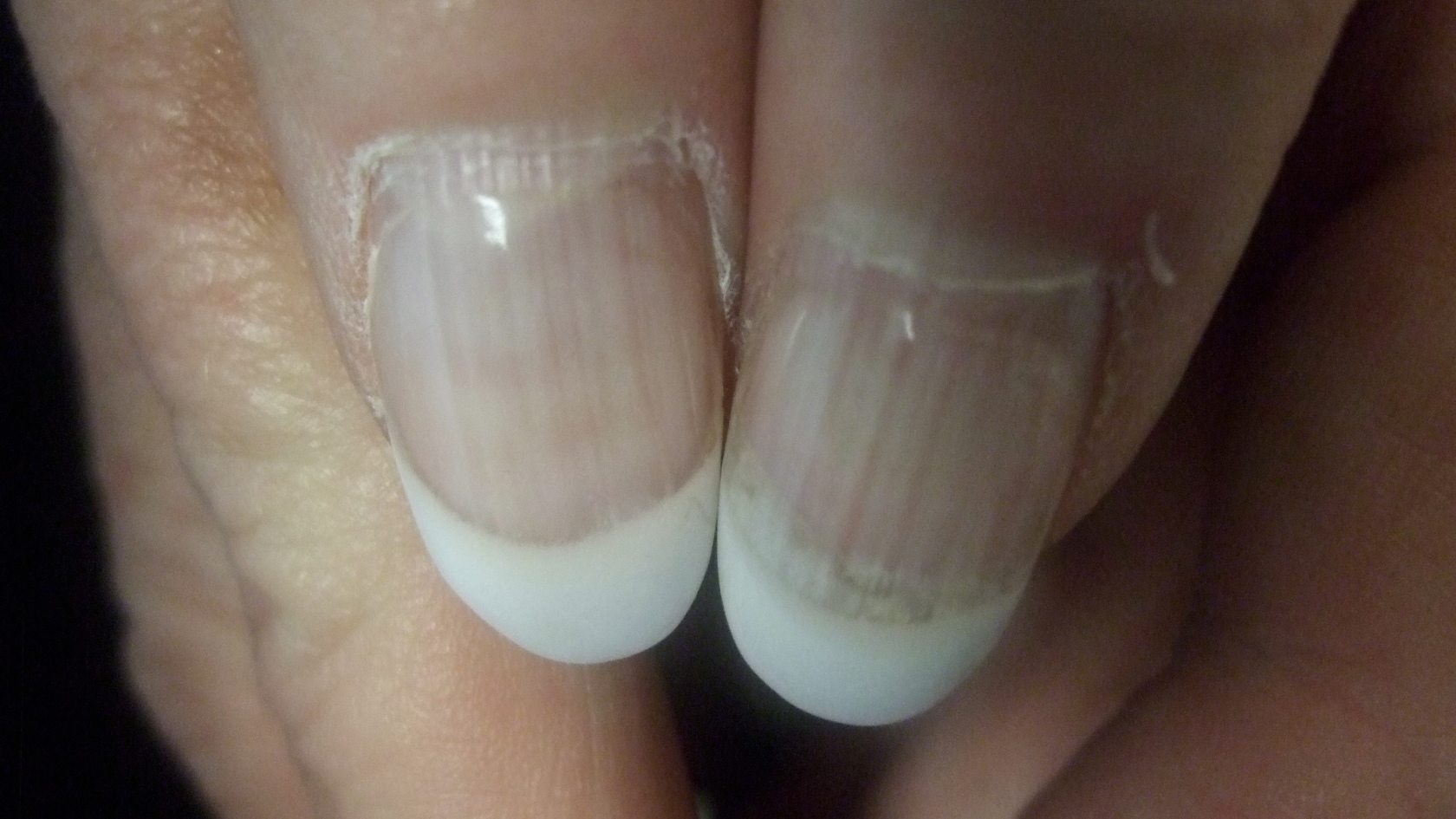 Transverse Lines of the Nails | The American Journal of Medicine Blog