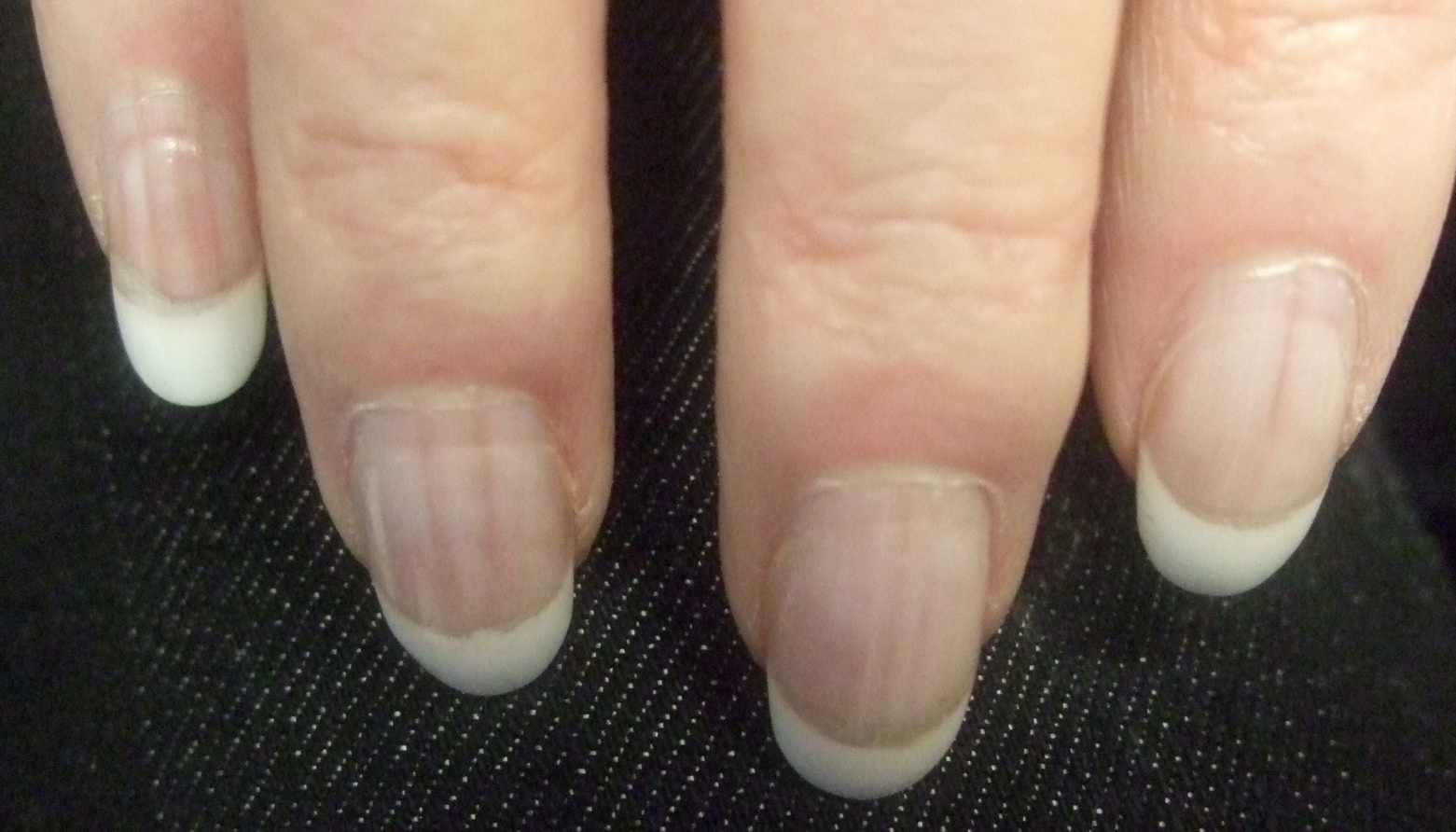 Multiple Linear Red Bands On The Fingernails Idiopathic Polydactylous