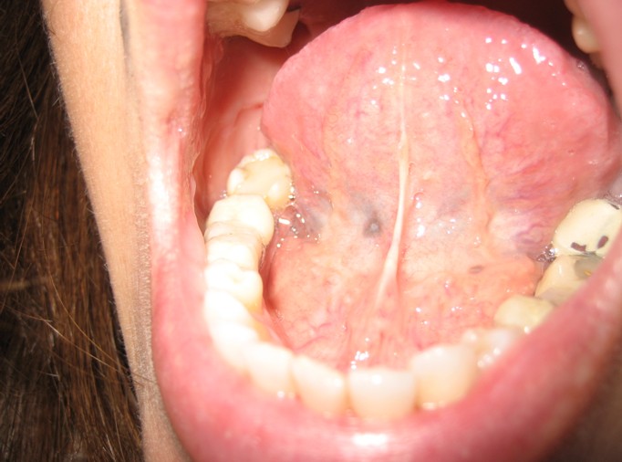 Pigmented Lesions  Pocket Dentistry