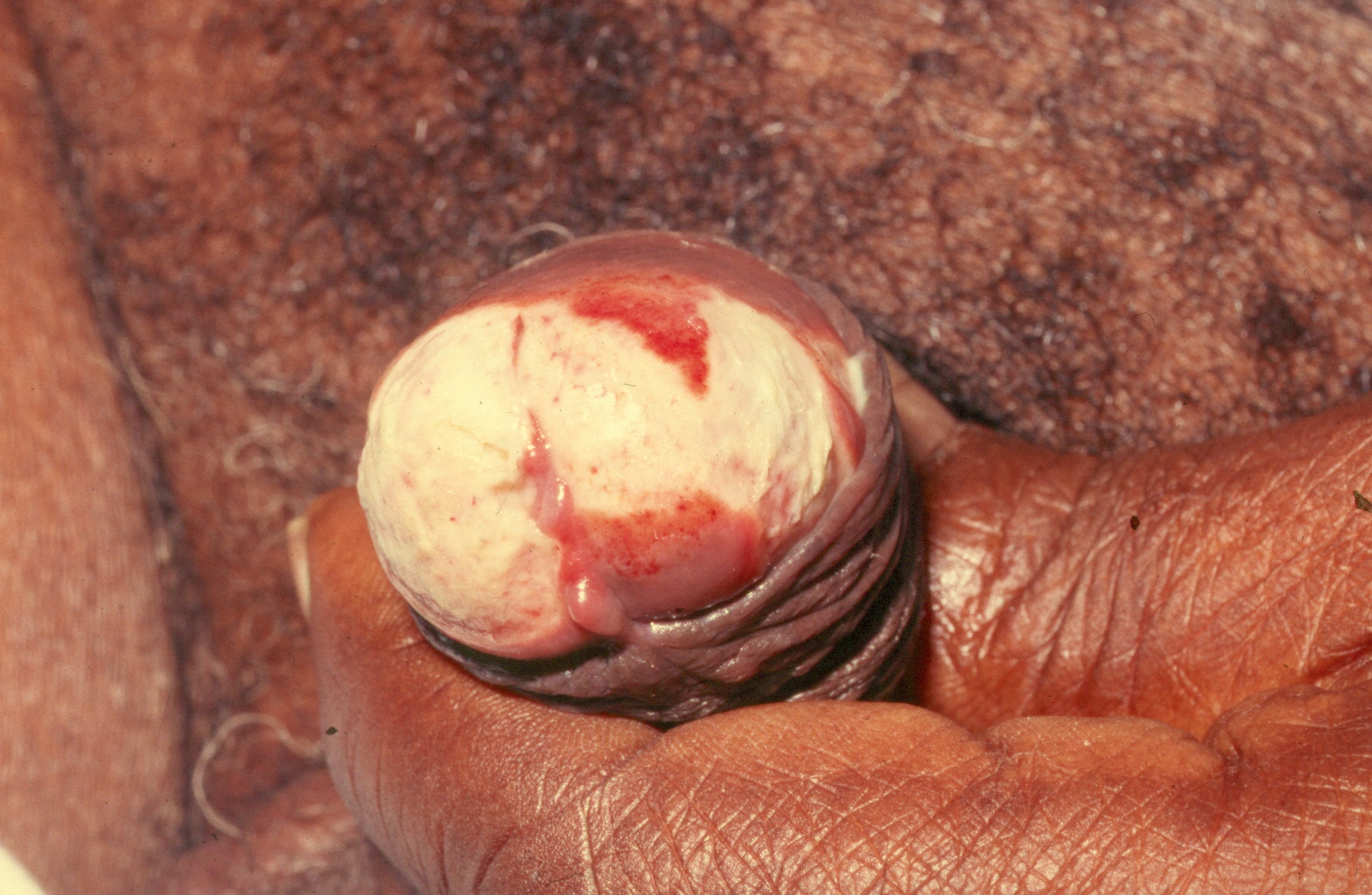 Mutilarea genitală a femeii | Zanzu