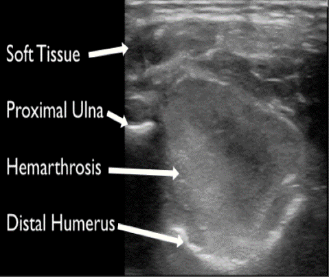  Non-injured distal arm for comparison. 
