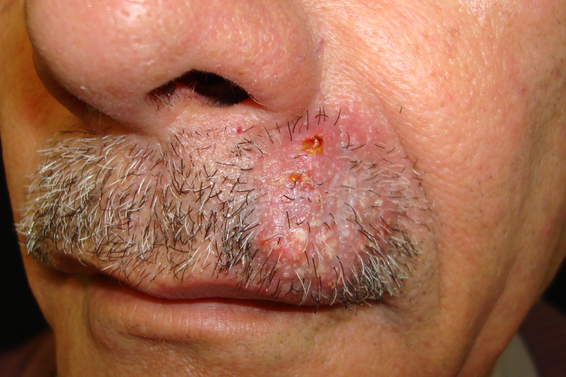 Dermatomycosis barbae, AKA fungal neckbearditis. [Warning: gross
