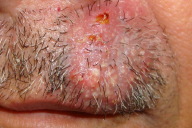 Dermatomycosis barbae, AKA fungal neckbearditis. [Warning: gross