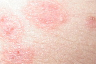 Vesicular pityriasis rosea: an atypical presentation