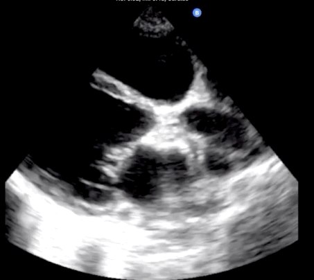 Trans-thoracic echocardiogram1
