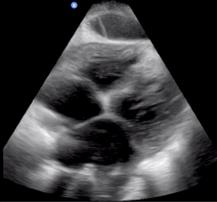 Trans-thoracic echocardiogram