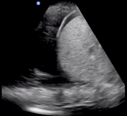 Right upper quadrant