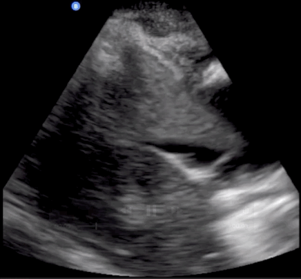 Right upper quadrant