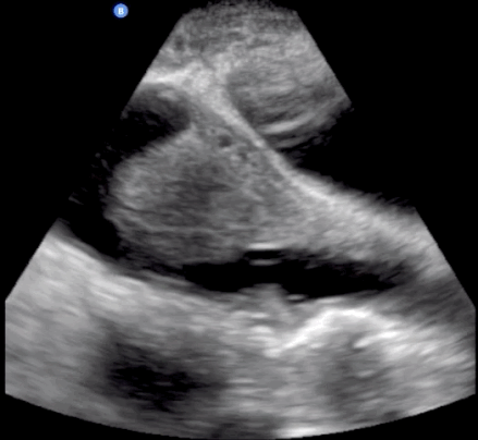 Sagittal pelvic