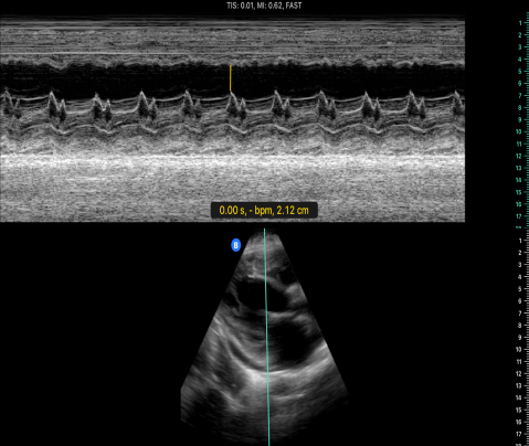 E-point Septal Separation