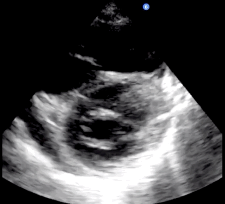 Trans-thoracic echocardiogram2