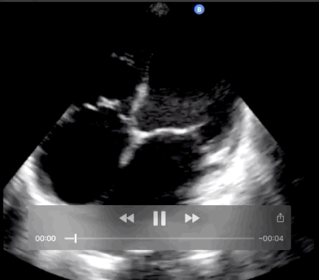 Trans-thoracic echocardiogram, apical 4 chamber
