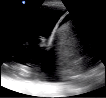 Right upper quadrant