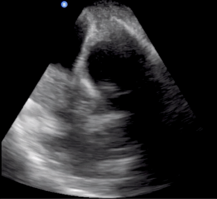 Sagittal pelvic