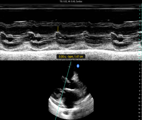 E-point Septal Separation measuring
