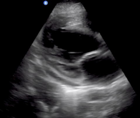 Trans-thoracic echocardiogram