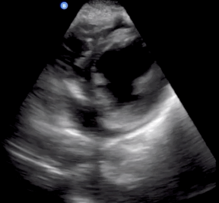Trans-thoracic echocardiogram