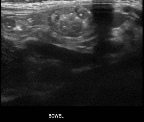 Transverse abdominal images