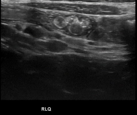 Transverse abdominal images
