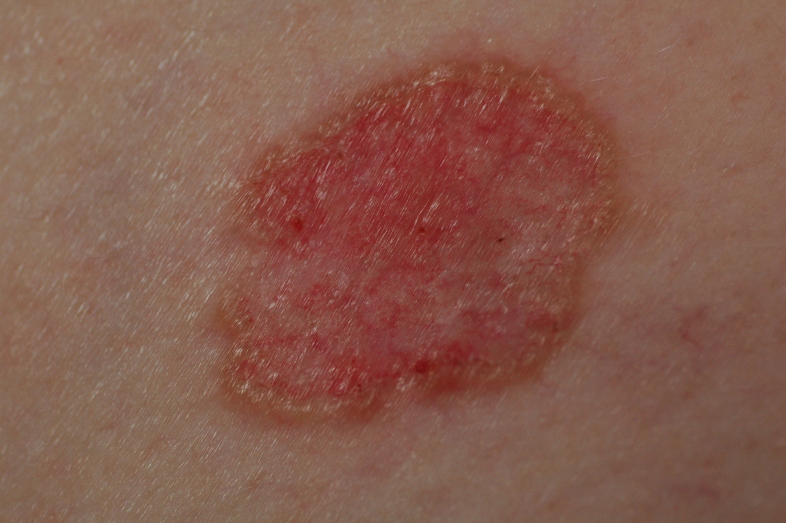 Early Stage Basal Cell Carcinoma Images