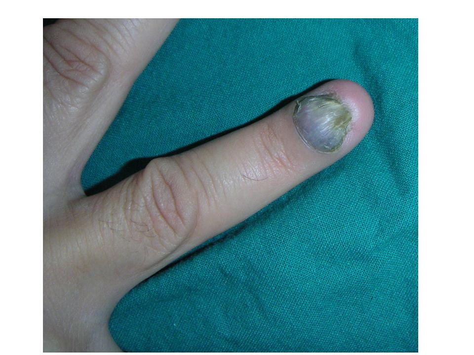 A misdiagnosed nail bed melanoma