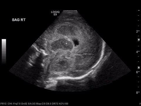  Coronal video 