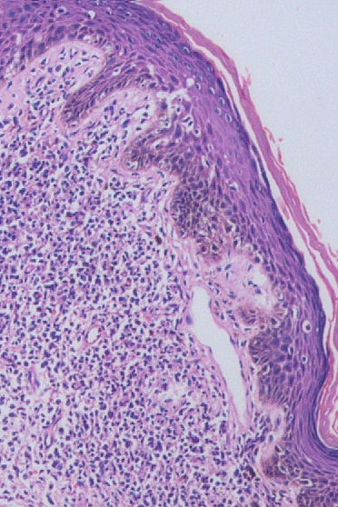 cutaneous tcel lymphoma