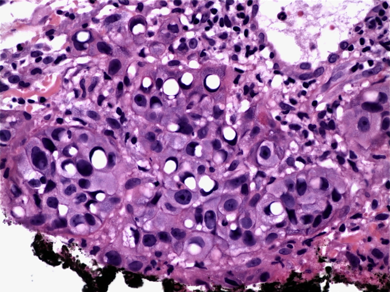 Signet-Ring Cell Gastric Adenocarcinoma: Image of the Month
