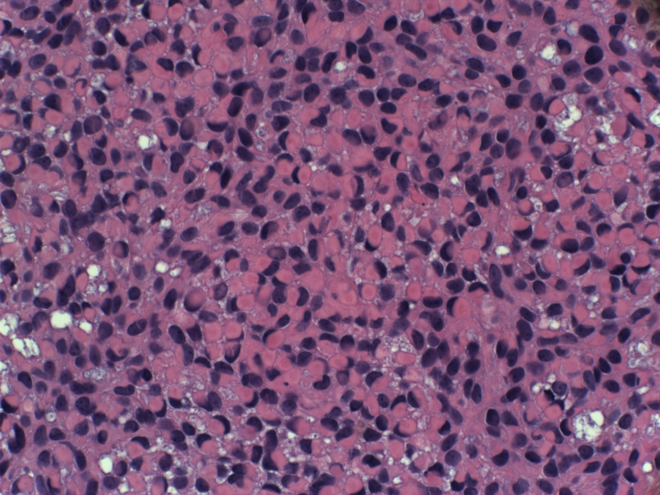 JCDR - Lymph node, Immunohistochemistry, Metastasis, S100