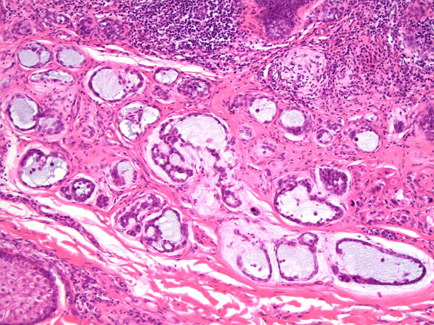 Small primary cutaneous mucinous carcinoma mimicking an early basal ...