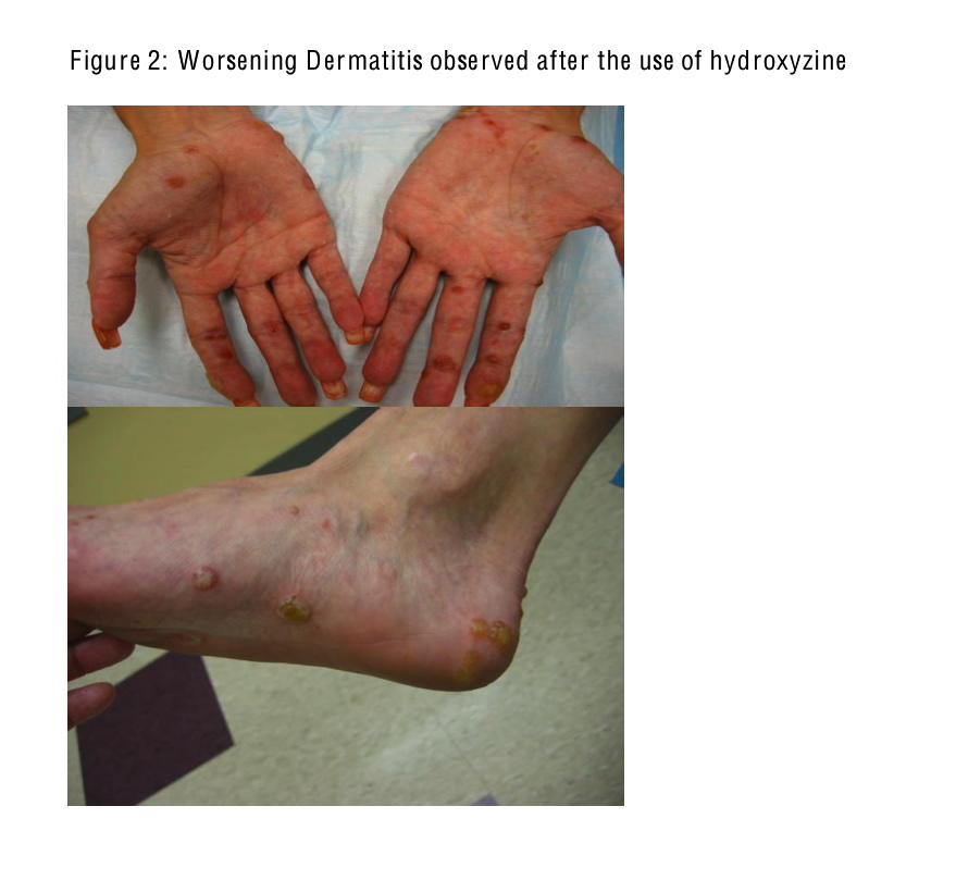 Worsening of contact dermatitis by oral hydroxyzine: A case report