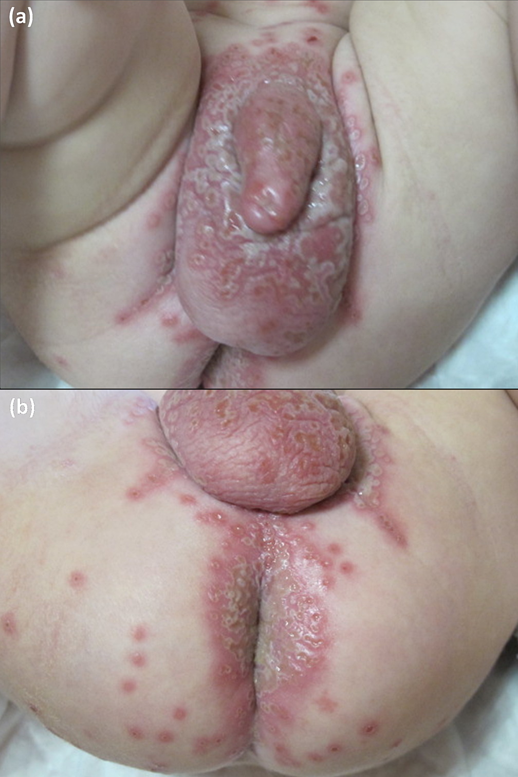 Genitaler herpes