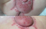 genital herpes on testicles