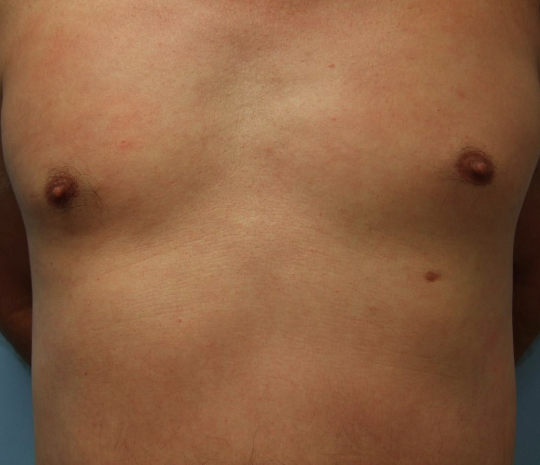 What Does Having a Third Nipple Mean? Supernumerary Nipples - GoodRx