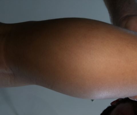  Photograph of the right calf. 
