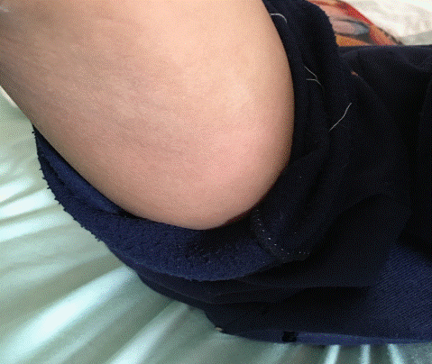  Photograph of the posterior right thigh. 