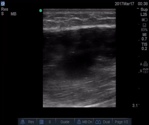  the gastrocnemius muscle in the long axis.