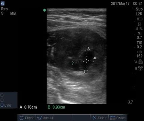  A still image of the right gastrocnemius in the short axis. 