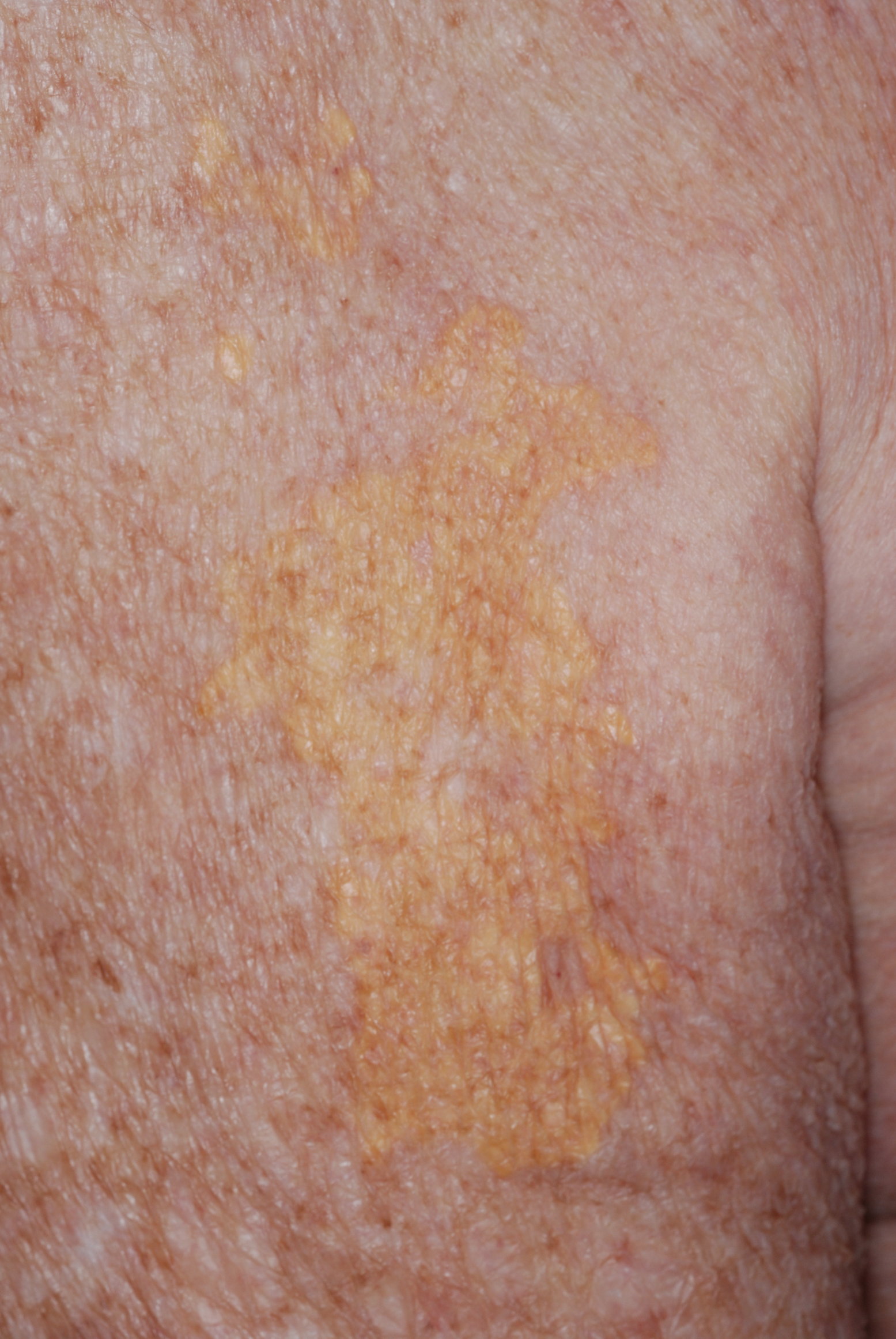 Yellow Spots On Skin Meaning At Brandon Harding Blog