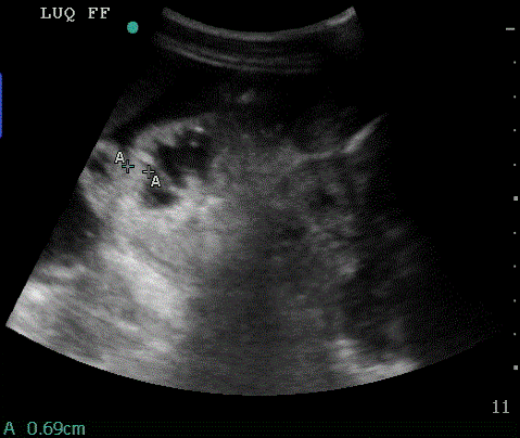  Free fluid in the splenorenal 