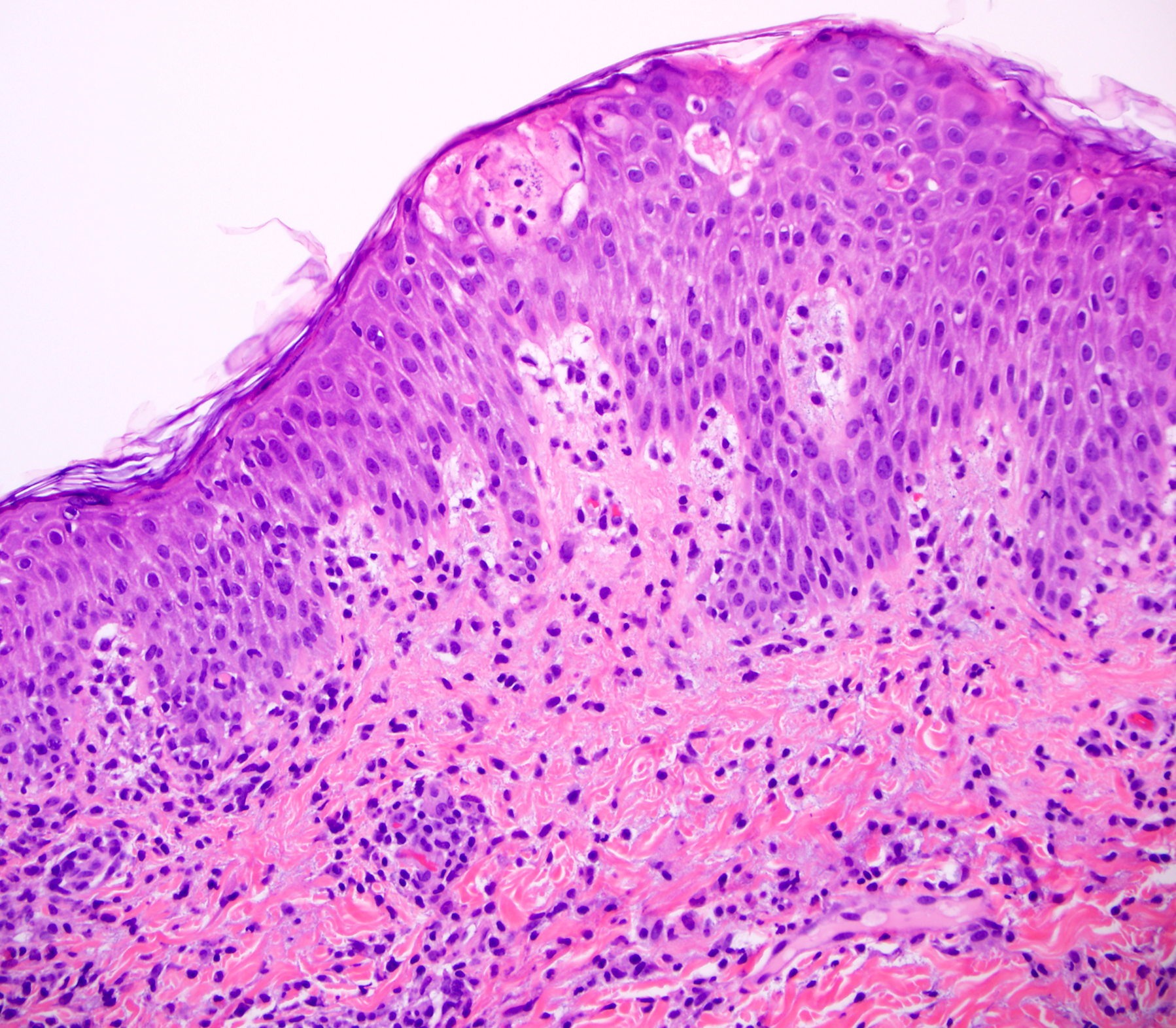 A Case Of Drug Rash With Eosinophilia And Systemic Symptoms (dress 