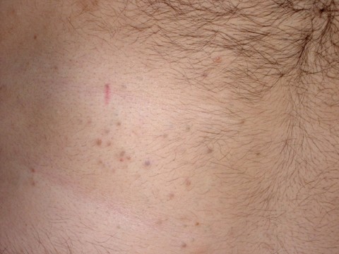 Surgical  Cosmetic Dermatology  Dermoscopy of eruptive vellus hair cyst