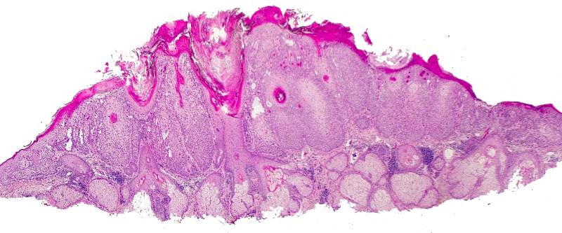 Actinic Keratosis Squamous Cell Carcinoma