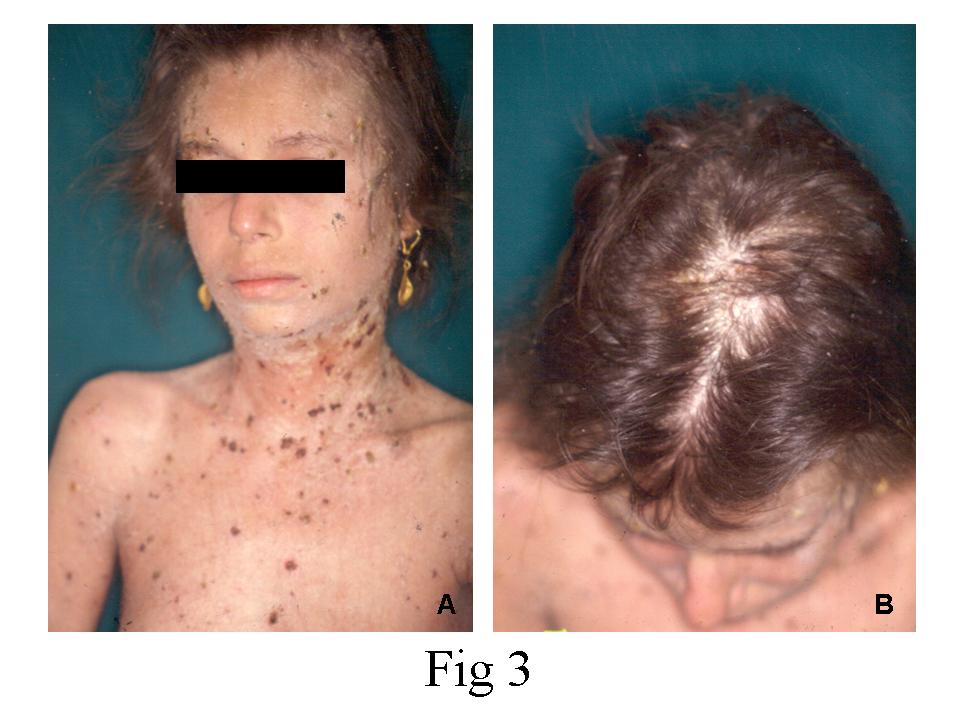 Scabies On Face Photos