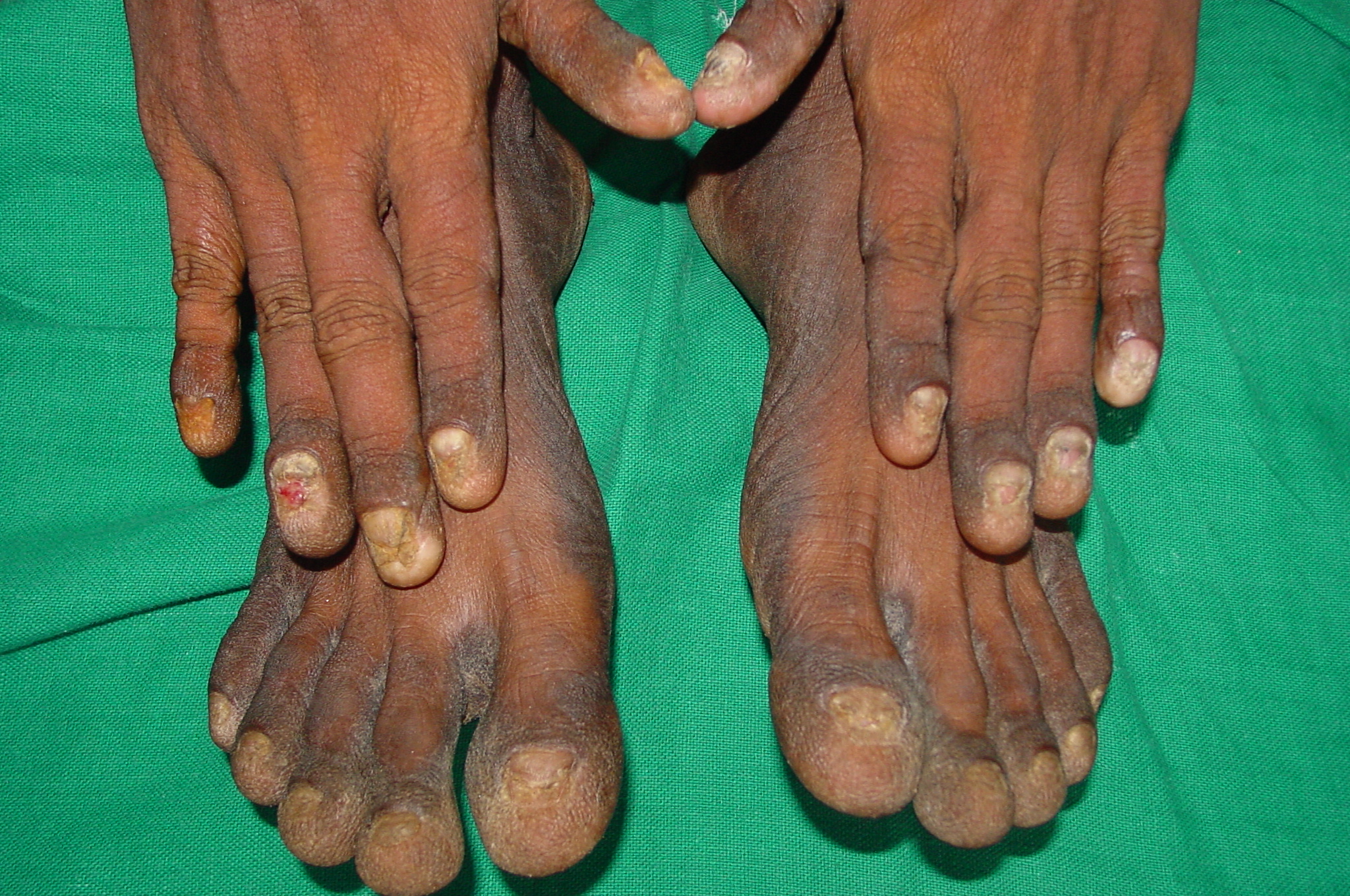 Yellow nail syndrome | Eurorad