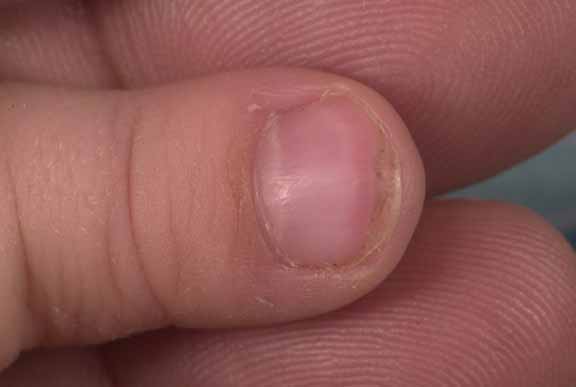 Rubinstein-Taybi syndrome (broad thumb-hallux syndrome)